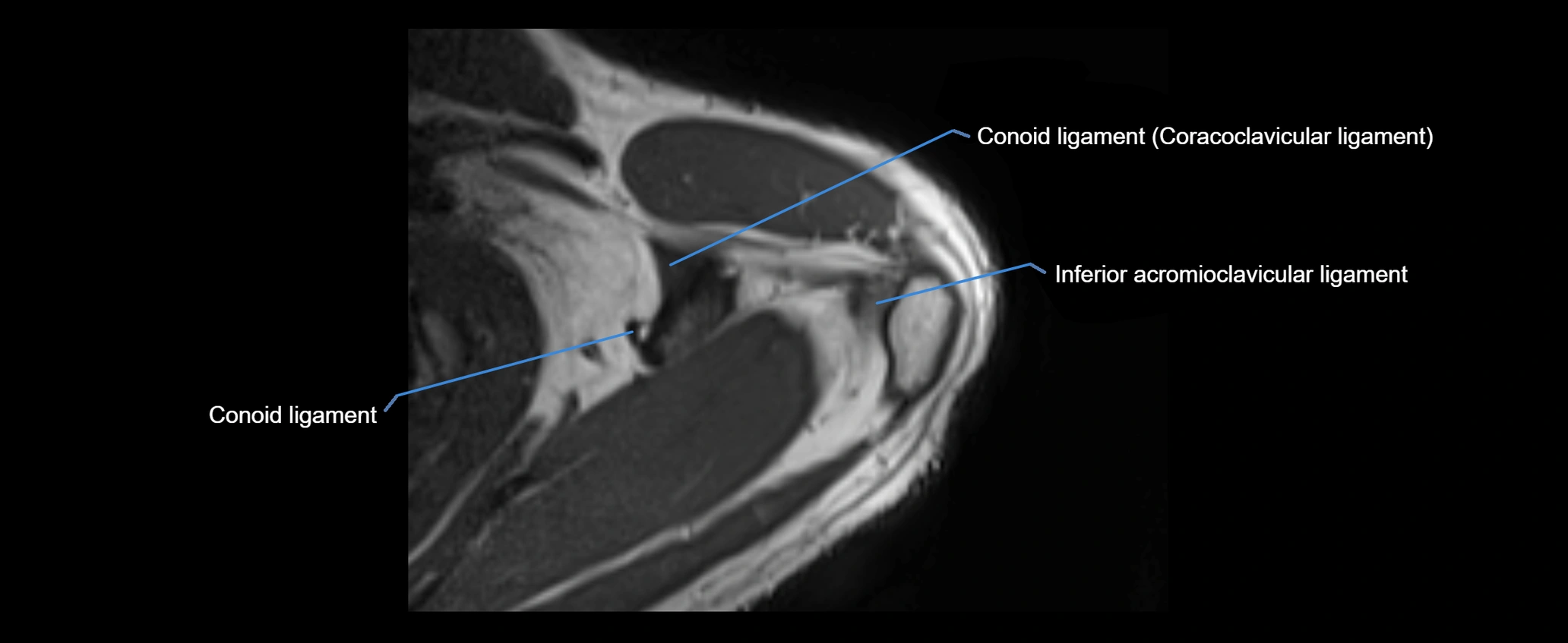 shoulder ligaments axial 3d 3t mri image-img-00005-00029.webp
